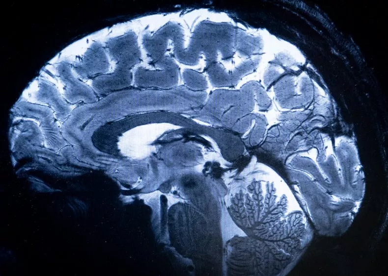 Dementia Breakthrough 'Vital' for Future Treatment: Scientists